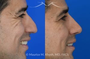 Photo of a patient before and after a procedure. Liquid rhinoplasty - This delightful patient disliked the nasal hump and droopy nasal tip. He was not ready for a surgical rhinoplasty. We performed liquid rhinoplasty in New York to elevate his nasal tip and straighten the nasal hump. Note that the nose tip does not droop even when he smiles. 