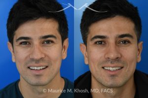 Photo of a patient before and after a procedure. Liquid rhinoplasty - This delightful patient disliked the nasal hump and droopy nasal tip. He was not ready for a surgical rhinoplasty. We performed liquid rhinoplasty in New York to elevate his nasal tip and straighten the nasal hump. Note that the nose tip does not droop even when he smiles. 