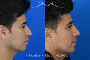 Photo of a patient before and after a procedure. Liquid rhinoplasty - This delightful patient disliked the nasal hump and droopy nasal tip. He was not ready for a surgical rhinoplasty. We performed liquid rhinoplasty in New York to elevate his nasal tip and straighten the nasal hump. Note that the nose tip does not droop even when he smiles. 