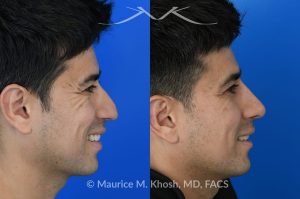 Photo of a patient before and after a procedure. Liquid rhinoplasty - This delightful patient disliked the nasal hump and droopy nasal tip. He was not ready for a surgical rhinoplasty. We performed liquid rhinoplasty in New York to elevate his nasal tip and straighten the nasal hump. Note that the nose tip does not droop even when he smiles. 