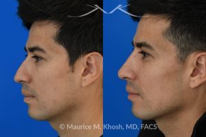 Photo of a patient before and after a procedure. Liquid rhinoplasty - This delightful patient disliked the nasal hump and droopy nasal tip. He was not ready for a surgical rhinoplasty. We performed liquid rhinoplasty in New York to elevate his nasal tip and straighten the nasal hump. Note that the nose tip does not droop even when he smiles. 