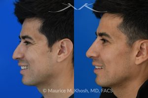 Photo of a patient before and after a procedure. Liquid rhinoplasty - This delightful patient disliked the nasal hump and droopy nasal tip. He was not ready for a surgical rhinoplasty. We performed liquid rhinoplasty in New York to elevate his nasal tip and straighten the nasal hump. Note that the nose tip does not droop even when he smiles. 