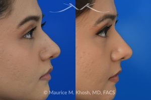 Photo of a patient before and after a procedure. Female patient before and after Liquid rhinoplasty - Liquid rhinoplasty in NYC for subtle improvement of the nasal tip and the bridge of the nose using facial fillers. Precise placement of minimal amounts of facial filler into the bridge of the nose and the nasal tip allowed our delightful patient to achieve a smooth nasal profile and a more proportioned and slightly elevated nasal tip. 
