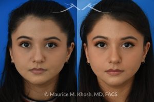 Photo of a patient before and after a procedure. Female patient before and after Liquid rhinoplasty - Liquid rhinoplasty in NYC for subtle improvement of the nasal tip and the bridge of the nose using facial fillers. Precise placement of minimal amounts of facial filler into the bridge of the nose and the nasal tip allowed our delightful patient to achieve a smooth nasal profile and a more proportioned and slightly elevated nasal tip. 
