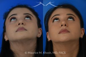 Photo of a patient before and after a procedure. Female patient before and after Liquid rhinoplasty - Liquid rhinoplasty in NYC for subtle improvement of the nasal tip and the bridge of the nose using facial fillers. Precise placement of minimal amounts of facial filler into the bridge of the nose and the nasal tip allowed our delightful patient to achieve a smooth nasal profile and a more proportioned and slightly elevated nasal tip. 
