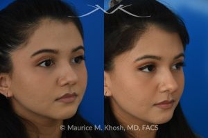 Photo of a patient before and after a procedure. Female patient before and after Liquid rhinoplasty - Liquid rhinoplasty in NYC for subtle improvement of the nasal tip and the bridge of the nose using facial fillers. Precise placement of minimal amounts of facial filler into the bridge of the nose and the nasal tip allowed our delightful patient to achieve a smooth nasal profile and a more proportioned and slightly elevated nasal tip. 
