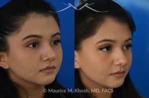 Photo of a patient before and after a procedure. Female patient before and after Liquid rhinoplasty - Liquid rhinoplasty in NYC for subtle improvement of the nasal tip and the bridge of the nose using facial fillers. Precise placement of minimal amounts of facial filler into the bridge of the nose and the nasal tip allowed our delightful patient to achieve a smooth nasal profile and a more proportioned and slightly elevated nasal tip. 
