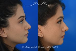 Photo of a patient before and after a procedure. Female patient before and after Liquid rhinoplasty - Liquid rhinoplasty in NYC for subtle improvement of the nasal tip and the bridge of the nose using facial fillers. Precise placement of minimal amounts of facial filler into the bridge of the nose and the nasal tip allowed our delightful patient to achieve a smooth nasal profile and a more proportioned and slightly elevated nasal tip. 
