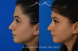 Photo of a patient before and after a procedure. Female patient before and after Liquid rhinoplasty - Liquid rhinoplasty in NYC for subtle improvement of the nasal tip and the bridge of the nose using facial fillers. Precise placement of minimal amounts of facial filler into the bridge of the nose and the nasal tip allowed our delightful patient to achieve a smooth nasal profile and a more proportioned and slightly elevated nasal tip. 