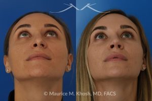 Photo of a patient before and after a procedure. Rhinoplasty (to elevate and refine nasal tip) - This delightful 30 year-old was interested in rhinoplasty in New York, to elevate and refine her nasal tip. An open approach rhinoplasty was used to rotate and shorten the tip. Providing the results which perfectly matched her expectations .