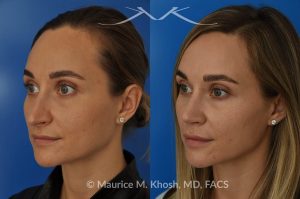 Photo of a patient before and after a procedure. Rhinoplasty (to elevate and refine nasal tip) - This delightful 30 year-old was interested in rhinoplasty in New York, to elevate and refine her nasal tip. An open approach rhinoplasty was used to rotate and shorten the tip. Providing the results which perfectly matched her expectations .