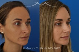 Photo of a patient before and after a procedure. Rhinoplasty (to elevate and refine nasal tip) - This delightful 30 year-old was interested in rhinoplasty in New York, to elevate and refine her nasal tip. An open approach rhinoplasty was used to rotate and shorten the tip. Providing the results which perfectly matched her expectations .