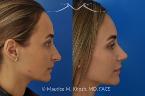 Photo of a patient before and after a procedure. Rhinoplasty (to elevate and refine nasal tip) - This delightful 30 year-old was interested in rhinoplasty in New York, to elevate and refine her nasal tip. An open approach rhinoplasty was used to rotate and shorten the tip. Providing the results which perfectly matched her expectations .