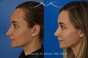 Photo of a patient before and after a procedure. Rhinoplasty (to elevate and refine nasal tip) - This delightful 30 year-old was interested in rhinoplasty in New York, to elevate and refine her nasal tip. An open approach rhinoplasty was used to rotate and shorten the tip. Providing the results which perfectly matched her expectations .