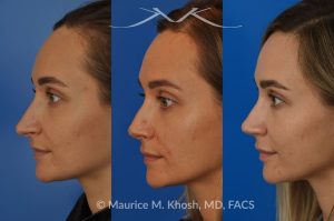 Photo of a patient before and after a procedure. Rhinoplasty (to elevate and refine nasal tip) - This delightful 30 year-old was interested in rhinoplasty in New York, to elevate and refine her nasal tip. An open approach rhinoplasty was used to rotate and shorten the tip. Providing the results which perfectly matched her expectations .