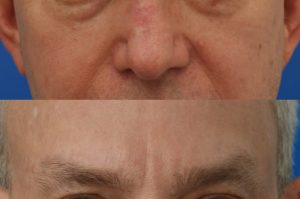 Photo of a patient before and after a procedure. Upper and lower blepharoplasty - This delightful 55 year old dislikes the puffy upper and lower eyelids which made him look tired and 'old'. He underwent upper and lower blepharoplasty in Manhattan. The excess skin and fat was removed from the upper eyelid through a perfectly hidden incision. The lower eyelid excess fat was removed from inside the eyelid, so as not to leave any scars.