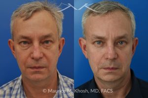 Photo of a patient before and after a procedure. Upper and lower blepharoplasty - This delightful 55 year old dislikes the puffy upper and lower eyelids which made him look tired and 'old'. He underwent upper and lower blepharoplasty in Manhattan. The excess skin and fat was removed from the upper eyelid through a perfectly hidden incision. The lower eyelid excess fat was removed from inside the eyelid, so as not to leave any scars.