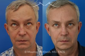 Photo of a patient before and after a procedure. Upper and lower blepharoplasty - This delightful 55 year old dislikes the puffy upper and lower eyelids which made him look tired and 'old'. He underwent upper and lower blepharoplasty in Manhattan. The excess skin and fat was removed from the upper eyelid through a perfectly hidden incision. The lower eyelid excess fat was removed from inside the eyelid, so as not to leave any scars.