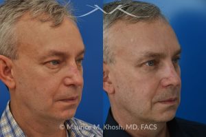 Photo of a patient before and after a procedure. Upper and lower blepharoplasty - This delightful 55 year old dislikes the puffy upper and lower eyelids which made him look tired and 'old'. He underwent upper and lower blepharoplasty in Manhattan. The excess skin and fat was removed from the upper eyelid through a perfectly hidden incision. The lower eyelid excess fat was removed from inside the eyelid, so as not to leave any scars.