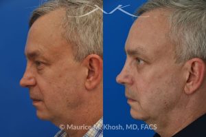 Photo of a patient before and after a procedure. Upper and lower blepharoplasty - This delightful 55 year old dislikes the puffy upper and lower eyelids which made him look tired and 'old'. He underwent upper and lower blepharoplasty in Manhattan. The excess skin and fat was removed from the upper eyelid through a perfectly hidden incision. The lower eyelid excess fat was removed from inside the eyelid, so as not to leave any scars.