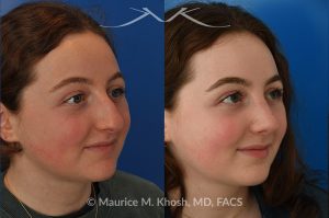 Photo of a patient before and after a procedure. Rhinoplasty for droopy tip and nasal hump - This delightful 18 year old was not happy with the external appearance of her nose. She disliked the nasal hump, the droopy tip, and the ''unrefined'' shape of her nose. She underwent an open approach rhinoplasty in New York. The dorsal height was reduced, the nasal tip was elevated, and the tip was narrowed and refined. The post op pictures show her at 6 months post op. She is ecstatic with the outcome of her rhinoplasty.