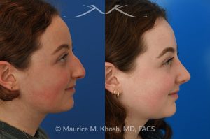 Photo of a patient before and after a procedure. Rhinoplasty for droopy tip and nasal hump - This delightful 18 year old was not happy with the external appearance of her nose. She disliked the nasal hump, the droopy tip, and the ''unrefined'' shape of her nose. She underwent an open approach rhinoplasty in New York. The dorsal height was reduced, the nasal tip was elevated, and the tip was narrowed and refined. The post op pictures show her at 6 months post op. She is ecstatic with the outcome of her rhinoplasty.