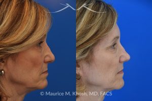 Photo of a patient before and after a procedure. Secondary repair of nostril retraction after attempted Mohs repair of the lower nose - This lovely 60 year-old had undergone repair of Mohs cancer removal from the left lower nose, by another surgeon. Unfortunately, this resulted in severe retraction of the left nostril and an unacceptable nasal deformity. 
Rhinoplasty to address nostril retraction was performed in Manhattan. Cartilage graft to the left nostril and composite graft (combination of skin and cartilage graft) to the inside edge of the nostril, helped to restore normality to the nose. The post op pictures are 6 months following her rhinoplasty.