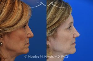 Photo of a patient before and after a procedure. Secondary repair of nostril retraction after attempted Mohs repair of the lower nose - This lovely 60 year-old had undergone repair of Mohs cancer removal from the left lower nose, by another surgeon. Unfortunately, this resulted in severe retraction of the left nostril and an unacceptable nasal deformity. 
Rhinoplasty to address nostril retraction was performed in Manhattan. Cartilage graft to the left nostril and composite graft (combination of skin and cartilage graft) to the inside edge of the nostril, helped to restore normality to the nose. The post op pictures are 6 months following her rhinoplasty.