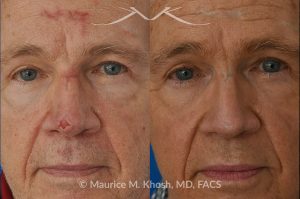 Photo of a patient before and after a procedure. Secondary repair of nasal tip defect following Mohs excision of skin cancer - This 76 year old had undergone excision of a basal cell cancer from the tip of his nose. He was dismayed at the highly visible depressed scar in his tip. Local tissue advancement flaps, followed by a series of microneedling treatments helped to restore his nasal tip to a normal appearance.