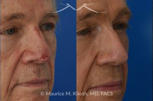 Photo of a patient before and after a procedure. Secondary repair of nasal tip defect following Mohs excision of skin cancer - This 76 year old had undergone excision of a basal cell cancer from the tip of his nose. He was dismayed at the highly visible depressed scar in his tip. Local tissue advancement flaps, followed by a series of microneedling treatments helped to restore his nasal tip to a normal appearance.