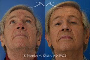 Photo of a patient before and after a procedure. Secondary repair of nasal tip defect following Mohs excision of skin cancer - This 76 year old had undergone excision of a basal cell cancer from the tip of his nose. He was dismayed at the highly visible depressed scar in his tip. Local tissue advancement flaps, followed by a series of microneedling treatments helped to restore his nasal tip to a normal appearance.