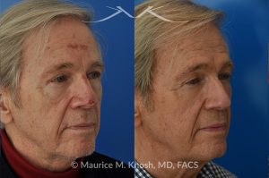 Photo of a patient before and after a procedure. Secondary repair of nasal tip defect following Mohs excision of skin cancer - This 76 year old had undergone excision of a basal cell cancer from the tip of his nose. He was dismayed at the highly visible depressed scar in his tip. Local tissue advancement flaps, followed by a series of microneedling treatments helped to restore his nasal tip to a normal appearance.