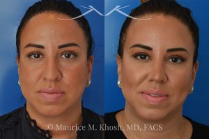 Photo of a patient before and after a procedure. Rhinoplasty to refine and elevate the tip and eliminate nasal hump - This lovely patient sought rhinoplasty in our Manhattan office to address a moderate size hump and to improve the nasal tip. She disliked the droopy nasal tip with poor definition. Rhinoplasty performed through the open approach allowed refinement and rotation of the nasal tip, and smoothing of the nasal hump.