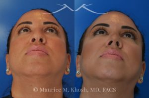 Photo of a patient before and after a procedure. Rhinoplasty to refine and elevate the tip and eliminate nasal hump - This lovely patient sought rhinoplasty in our Manhattan office to address a moderate size hump and to improve the nasal tip. She disliked the droopy nasal tip with poor definition. Rhinoplasty performed through the open approach allowed refinement and rotation of the nasal tip, and smoothing of the nasal hump.