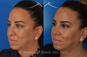Photo of a patient before and after a procedure. Rhinoplasty to refine and elevate the tip and eliminate nasal hump - This lovely patient sought rhinoplasty in our Manhattan office to address a moderate size hump and to improve the nasal tip. She disliked the droopy nasal tip with poor definition. Rhinoplasty performed through the open approach allowed refinement and rotation of the nasal tip, and smoothing of the nasal hump.