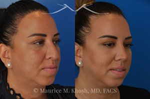 Photo of a patient before and after a procedure. Rhinoplasty to refine and elevate the tip and eliminate nasal hump - This lovely patient sought rhinoplasty in our Manhattan office to address a moderate size hump and to improve the nasal tip. She disliked the droopy nasal tip with poor definition. Rhinoplasty performed through the open approach allowed refinement and rotation of the nasal tip, and smoothing of the nasal hump.