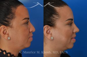 Photo of a patient before and after a procedure. Rhinoplasty to refine and elevate the tip and eliminate nasal hump - This lovely patient sought rhinoplasty in our Manhattan office to address a moderate size hump and to improve the nasal tip. She disliked the droopy nasal tip with poor definition. Rhinoplasty performed through the open approach allowed refinement and rotation of the nasal tip, and smoothing of the nasal hump.