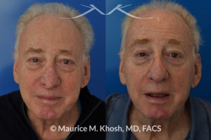Photo of a patient before and after a procedure. Nasal valve repair and revision rhinoplasty - This 73 year old had previously undergone rhinoplasty in his 20's. The surgery had left his nose deformed and severely obstructed. Revision rhinoplasty and repair of nasal vestibular stenosis was accomplished with use of cadaver rib cartilage. Revision surgery helped to restore a natural shape to the nose, and alleviate his breathing issues. He is delighted with the surgical results.
