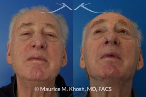 Photo of a patient before and after a procedure. Nasal valve repair and revision rhinoplasty - This 73 year old had previously undergone rhinoplasty in his 20's. The surgery had left his nose deformed and severely obstructed. Revision rhinoplasty and repair of nasal vestibular stenosis was accomplished with use of cadaver rib cartilage. Revision surgery helped to restore a natural shape to the nose, and alleviate his breathing issues. He is delighted with the surgical results.