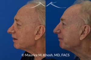 Photo of a patient before and after a procedure. Nasal valve repair and revision rhinoplasty - This 73 year old had previously undergone rhinoplasty in his 20's. The surgery had left his nose deformed and severely obstructed. Revision rhinoplasty and repair of nasal vestibular stenosis was accomplished with use of cadaver rib cartilage. Revision surgery helped to restore a natural shape to the nose, and alleviate his breathing issues. He is delighted with the surgical results.