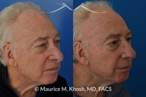 Photo of a patient before and after a procedure. Nasal valve repair and revision rhinoplasty - This 73 year old had previously undergone rhinoplasty in his 20's. The surgery had left his nose deformed and severely obstructed. Revision rhinoplasty and repair of nasal vestibular stenosis was accomplished with use of cadaver rib cartilage. Revision surgery helped to restore a natural shape to the nose, and alleviate his breathing issues. He is delighted with the surgical results.