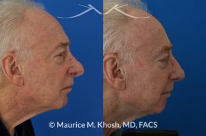 Photo of a patient before and after a procedure. Nasal valve repair and revision rhinoplasty - This 73 year old had previously undergone rhinoplasty in his 20's. The surgery had left his nose deformed and severely obstructed. Revision rhinoplasty and repair of nasal vestibular stenosis was accomplished with use of cadaver rib cartilage. Revision surgery helped to restore a natural shape to the nose, and alleviate his breathing issues. He is delighted with the surgical results.