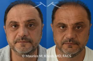 Photo of a patient before and after a procedure. Revision rhinoplasty, nasal valve reconstruction - This 53 year old had originally undergone rhinoplasty over 30 years ago. Surgery had left his nose pinched, depressed, short, and deformed. He had severe nasal obstruction. Revision rhinoplasty was performed with the use of his own rib cartilage to restore a normal shape to his nose and improve his breathing.
