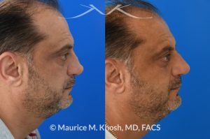 Photo of a patient before and after a procedure. Revision rhinoplasty, nasal valve reconstruction - This 53 year old had originally undergone rhinoplasty over 30 years ago. Surgery had left his nose pinched, depressed, short, and deformed. He had severe nasal obstruction. Revision rhinoplasty was performed with the use of his own rib cartilage to restore a normal shape to his nose and improve his breathing.