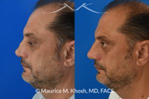 Photo of a patient before and after a procedure. Revision rhinoplasty, nasal valve reconstruction - This 53 year old had originally undergone rhinoplasty over 30 years ago. Surgery had left his nose pinched, depressed, short, and deformed. He had severe nasal obstruction. Revision rhinoplasty was performed with the use of his own rib cartilage to restore a normal shape to his nose and improve his breathing.