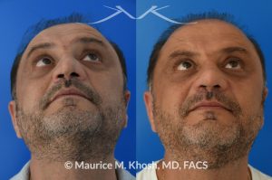 Photo of a patient before and after a procedure. Revision rhinoplasty, nasal valve reconstruction - This 53 year old had originally undergone rhinoplasty over 30 years ago. Surgery had left his nose pinched, depressed, short, and deformed. He had severe nasal obstruction. Revision rhinoplasty was performed with the use of his own rib cartilage to restore a normal shape to his nose and improve his breathing.