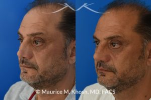 Photo of a patient before and after a procedure. Revision rhinoplasty, nasal valve reconstruction - This 53 year old had originally undergone rhinoplasty over 30 years ago. Surgery had left his nose pinched, depressed, short, and deformed. He had severe nasal obstruction. Revision rhinoplasty was performed with the use of his own rib cartilage to restore a normal shape to his nose and improve his breathing.