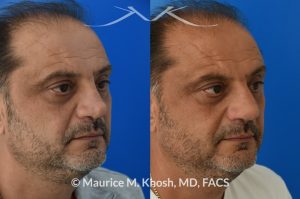 Photo of a patient before and after a procedure. Revision rhinoplasty, nasal valve reconstruction - This 53 year old had originally undergone rhinoplasty over 30 years ago. Surgery had left his nose pinched, depressed, short, and deformed. He had severe nasal obstruction. Revision rhinoplasty was performed with the use of his own rib cartilage to restore a normal shape to his nose and improve his breathing.
