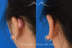Photo of a patient before and after a procedure. Ear keloid