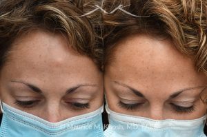 Photo of a patient before and after a procedure. Osteoma - This 43 year old had been bothered by the hard bony bump in the middle of her forehead. She travelled from out of town, for forehead osteoma removal in New York. She could not be more satisfied. The incision in the hairline is invisible six months after surgery. 